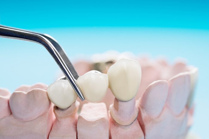 dental bridge treatment in canton, texas